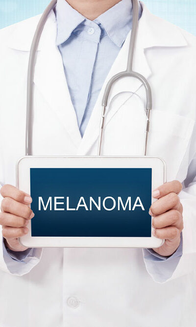 3 effective tips for dealing with melanoma