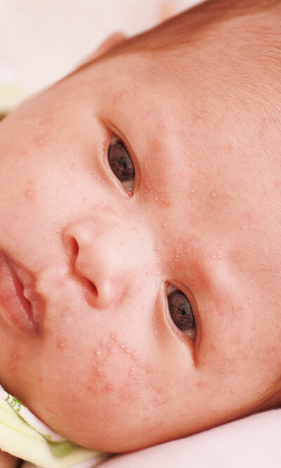 8 first-line treatments for atopic dermatitis in infants