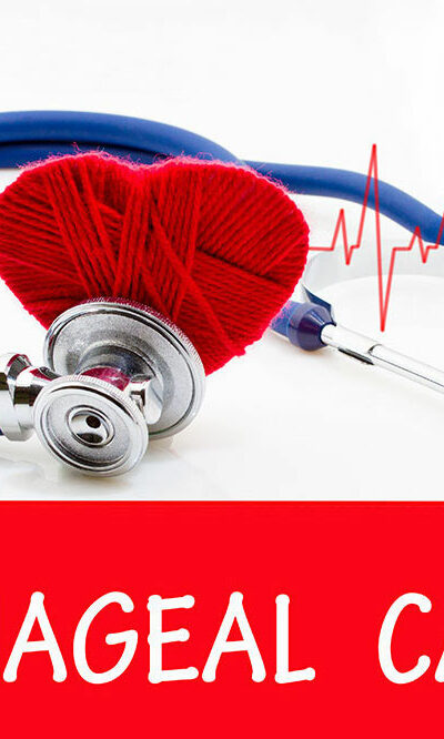 Esophageal cancer – Signs, causes, and management