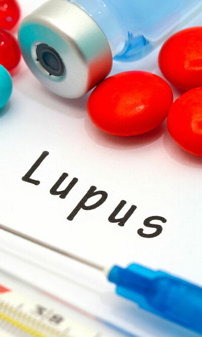 Lupus – Symptoms, Risk Factors, and Diagnosis