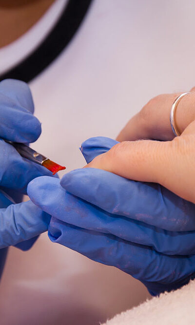 Nail fungal infection – Causes, symptoms, and management
